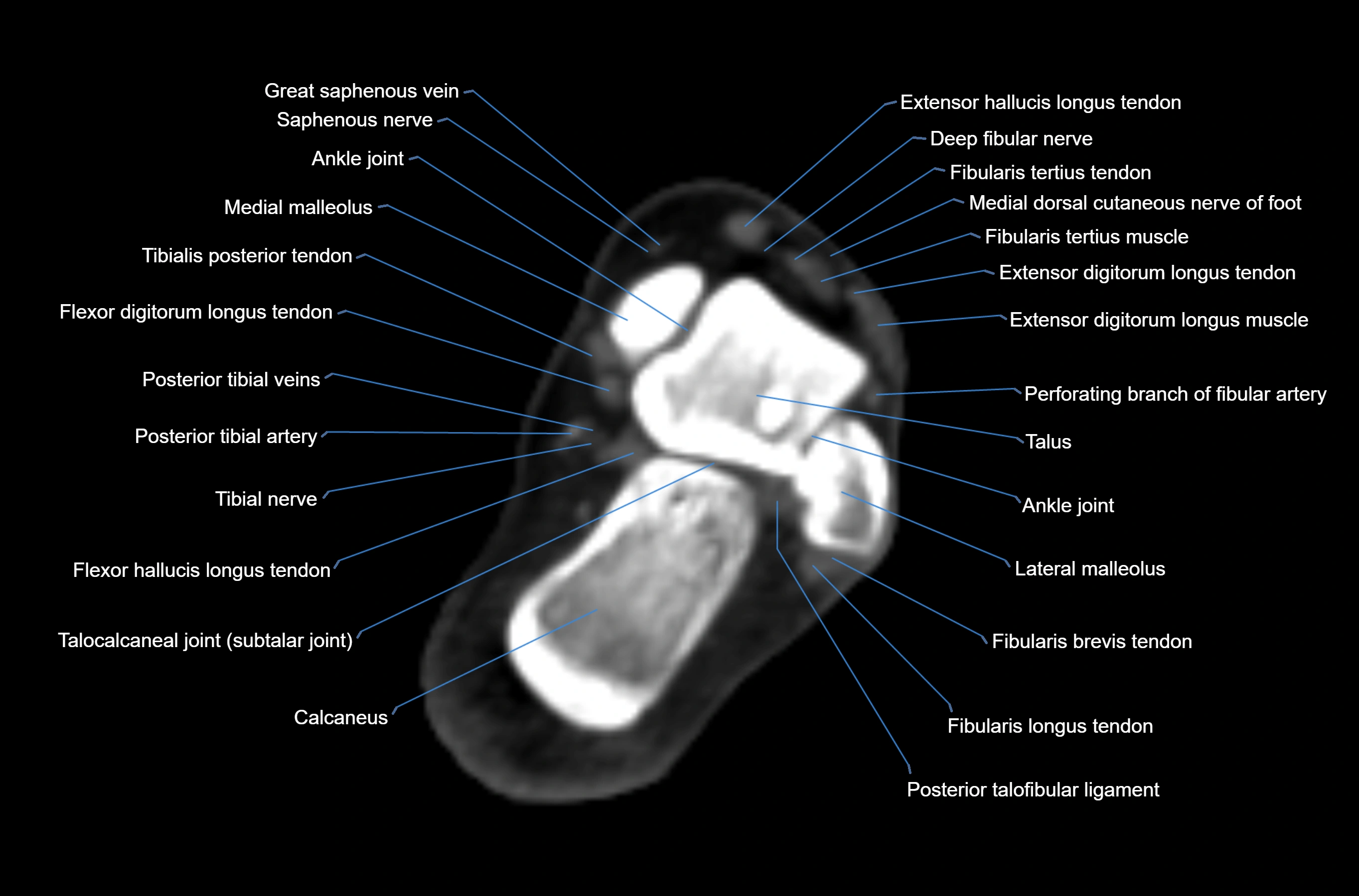 CT Ankle axial cross sectional anatomy labelled image -00032.webp